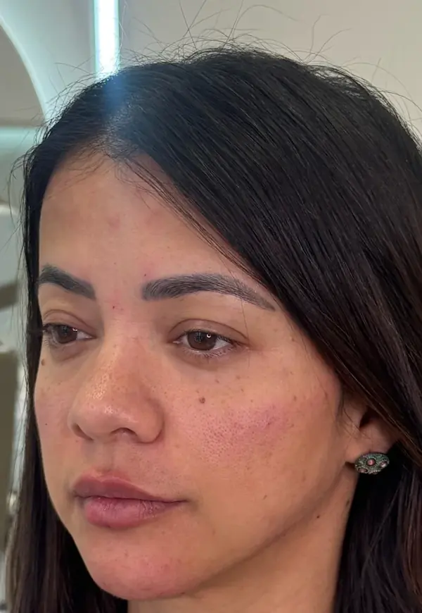 Paciente depois da harmonização facial, de três quartos