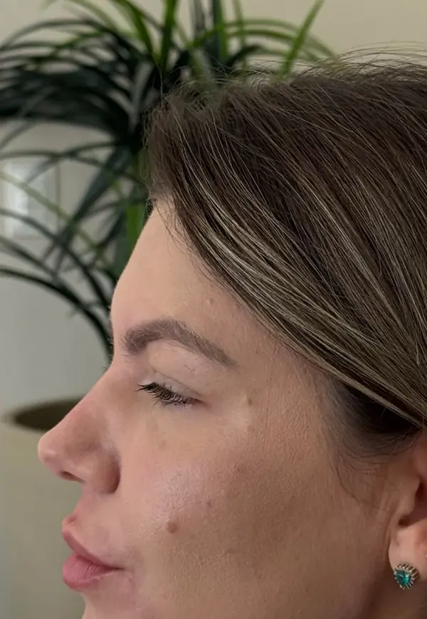 Depois: perfil mais harmônico