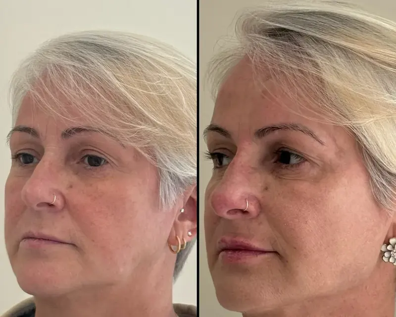 Rosto de paciente antes e depois do reposicionamento facial