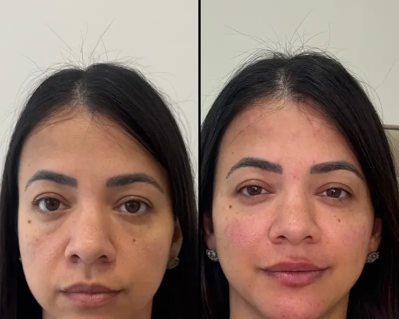 Rosto de frente antes e depois de uma harmonização sutil