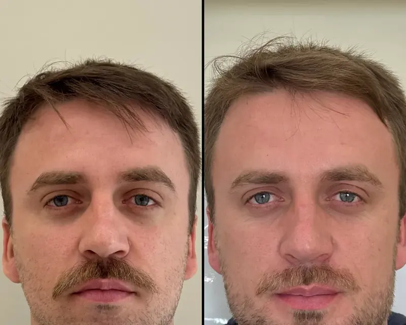 Homem de frente antes e depois da harmonização masculina